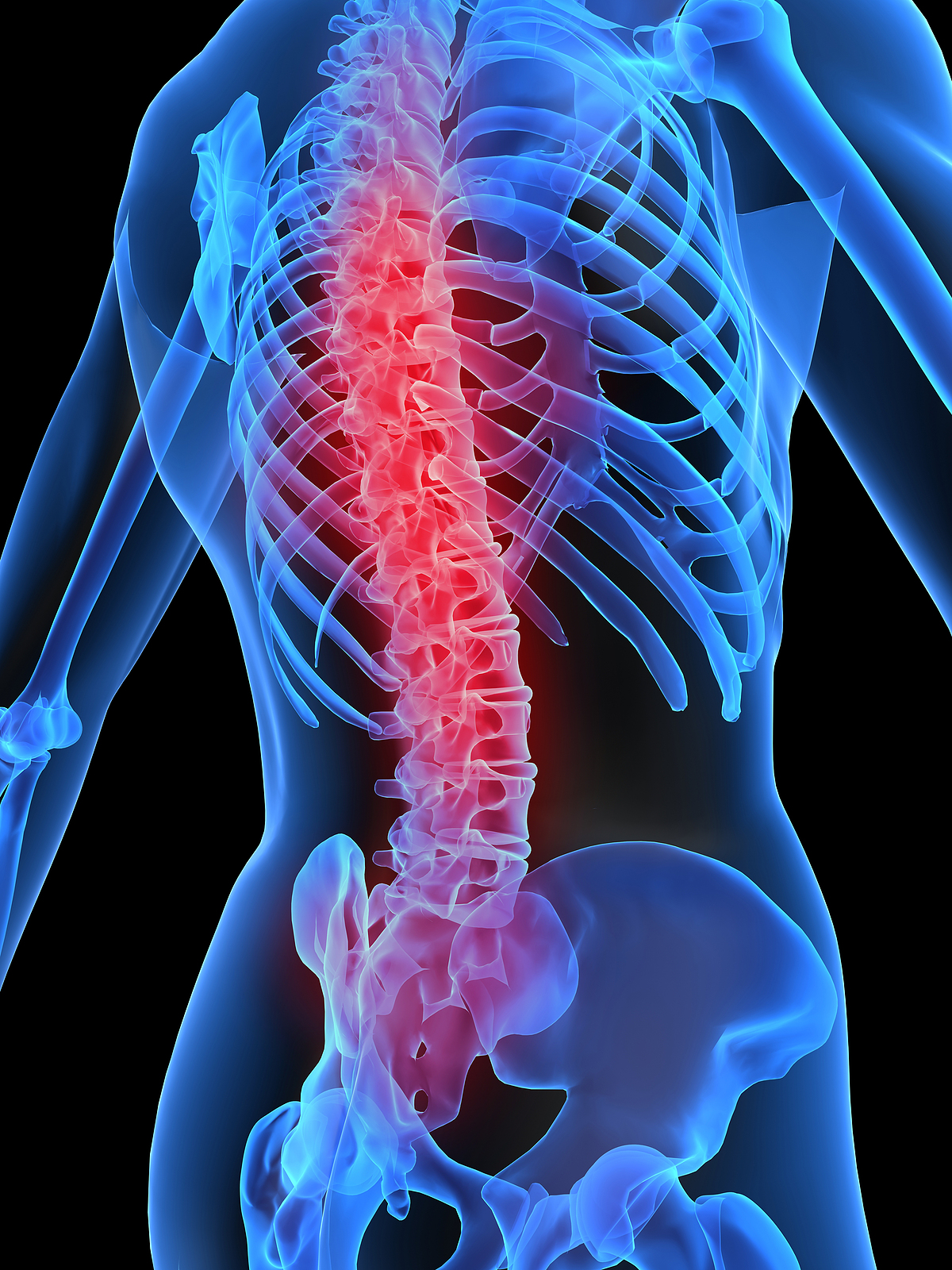 Radiografía de la columna y costillas con color rojo para indicar el dolor