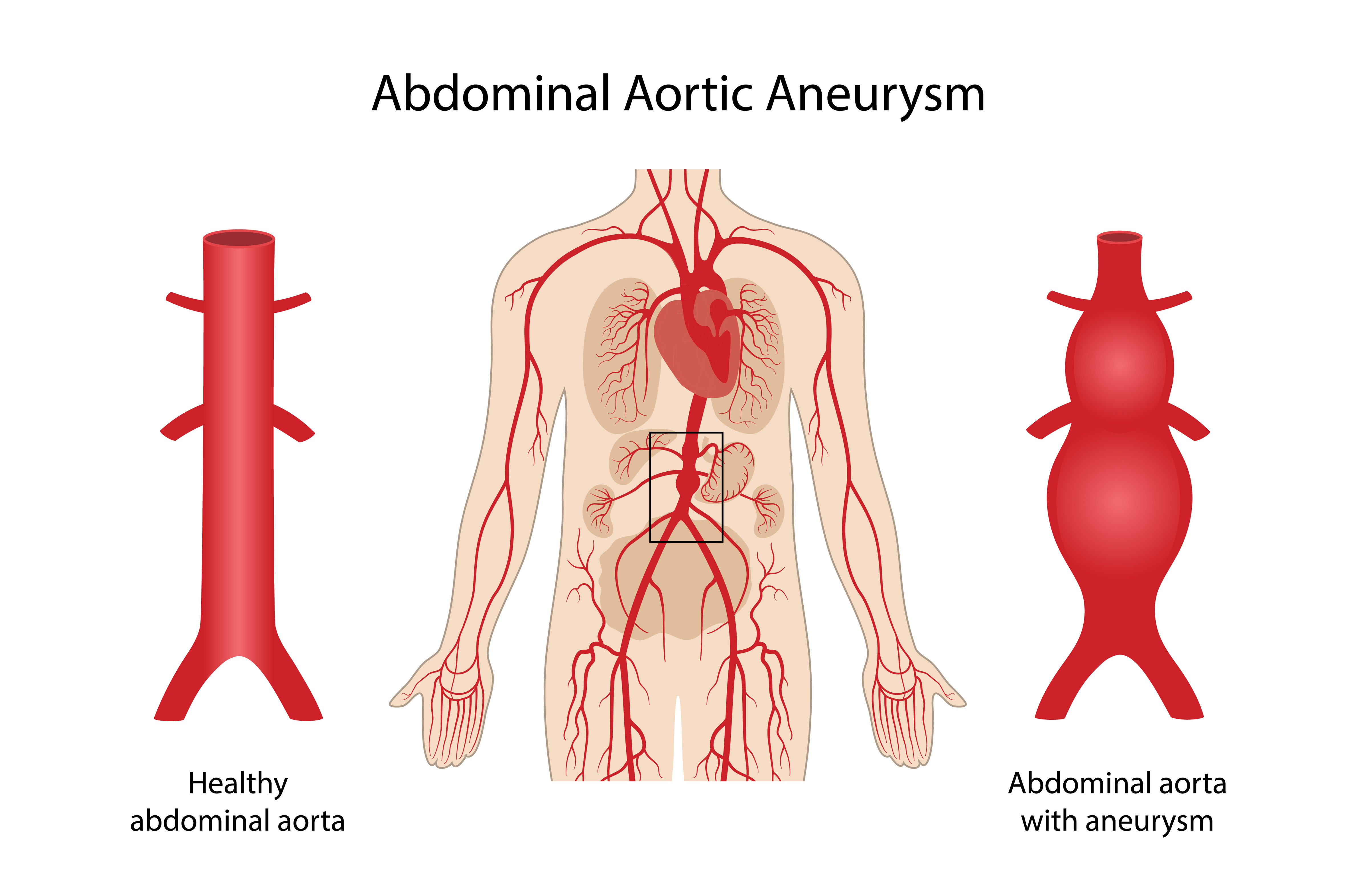 Abdominal aorta with aneurysm
