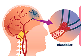 Skagit Regional Health -  Stroke Awareness